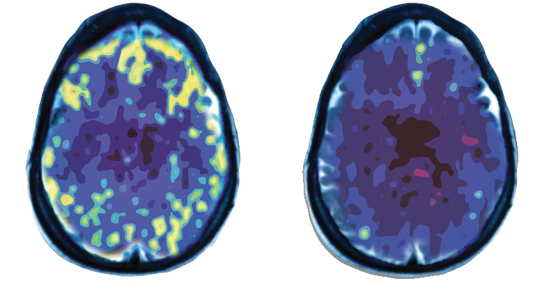 pet scane brain activity levels